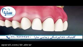 مقایسه ایمپلنت بریج دندان