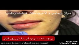 تزریق نیم سی سی ژل هیالورونیک اسید جهت برجسته سازی