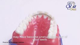 بهداشت ریتینر ثابت  دندانپزشکی سیمادنت