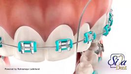 کشیدن نخ دندان ارتودنسی  دندانپزشکی سیمادنت
