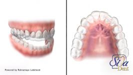ارتودنسی نامریی  دندانپزشکی سیمادنت