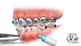 جدا شدن براکت  دندانپزشکی سیمادنت