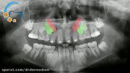 هدایت نیش نهفته در ارتودنسی  دکتر مسعود داوودیان