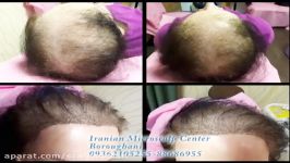 اسکالپ سر به روش 3D Hair By Hair  بروغنی