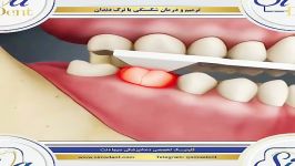 ترمیم درمان شکستگی یا ترک دندان  دندانپزشکی سیمادنت