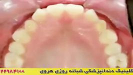 ارتودنسی دندان ها مرتب شدن دندان ها