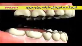 عواقب فقدان دندان پر نکردن جای خالی دندان