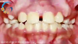 ارتودنسی ثابت بدون کشیدن دندان  دکتر مسعود داوودیان