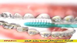 آموزش مسواک زدن دندان ها در زمان ارتودنسی + نخ دندان
