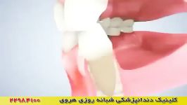 جرمگیری دندان درمان التهاب لثه