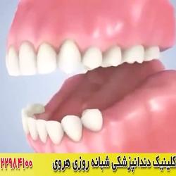 دندان مصنوعی برای دندان های ردیف عقب