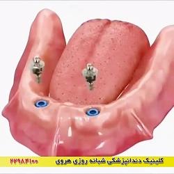 نقش ایمپلنت دندان در نصب دندان مصنوعی