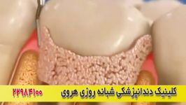 جرمگیری درمان بیماری لثه