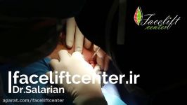 جراحی فیس لیفت در مرکز فیس لیفت ایران