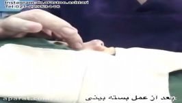 نمونه عمل جراحى بینى به روش بسته توسط دكتر اشترى