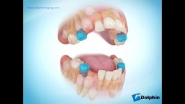 دکتر مسعود داودیان کشیدن سریال دندانها در ارتودنسی