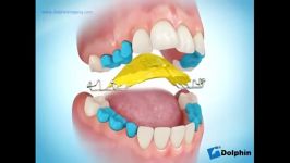 کراس بایت خلفی درمان پلاک ارتودنسی  دکتر داودیان