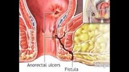 درمان قطعی فیستول مقعدی بدون عمل جراحی آنتی فیستولا کاستلینا