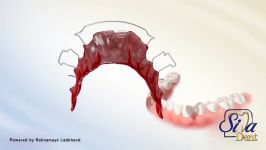 پلاک ارتودنسی  دندانپزشکی سیمادنت