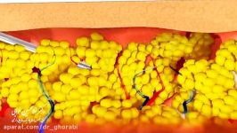 تخلیه چربی لیپوساکشن