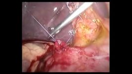 جراحی کله سیستکتومی لاپاروسکوپیک اکسپلور کلدوک حین عمل
