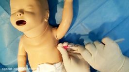 Neonatal chest drain insertion by Seldinger technique