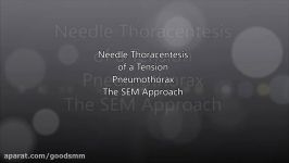 Needle Thoracentesis in Neonates Pneumothorax