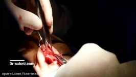 عمل جراحی بینی ترمیمی دکتر کسری ثابتی