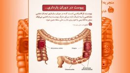 یبوست را جدی بگیرید... چون عوارضه اش جباران ناپذیر...