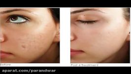 میکرونیدلینگ دکترپنDr. Pen Microneedling Syste