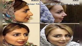 نمونه عملهاى جراحى بینى به روش بسته دكتر اشترى