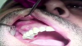تخلیه آبسه دندان برش جراحی