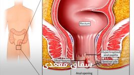 درمان قطعی شقاق مقعدی