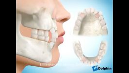 کشیدن دندان برای ارتودنسی  دکتر مسعود داودیان